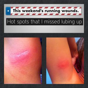 friction burns